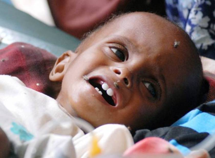 Θερίζει ο λιμός στη Σομαλία