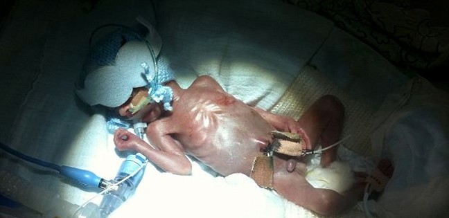 Σοκαριστικές φωτογραφίες: Βρέφος γεννήθηκε 450 γραμμάρια