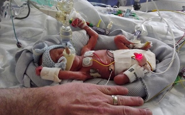 Σοκαριστικές φωτογραφίες: Βρέφος γεννήθηκε 450 γραμμάρια