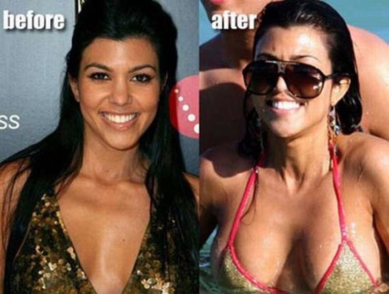 Διάσημες πριν και μετά την πλαστική στήθους (pics)