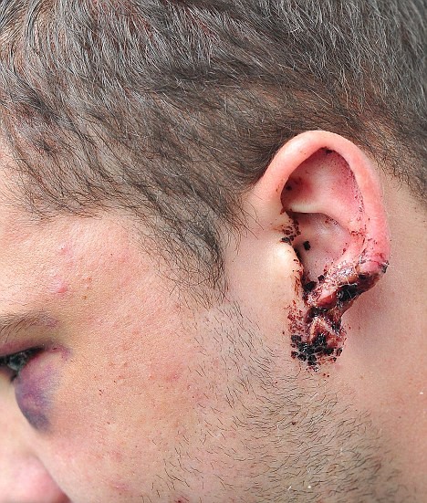 ΕΙΚΟΝΕΣ - ΣΟΚ: Του έκοψαν κομμάτι από το αυτί με δαγκωματιά 