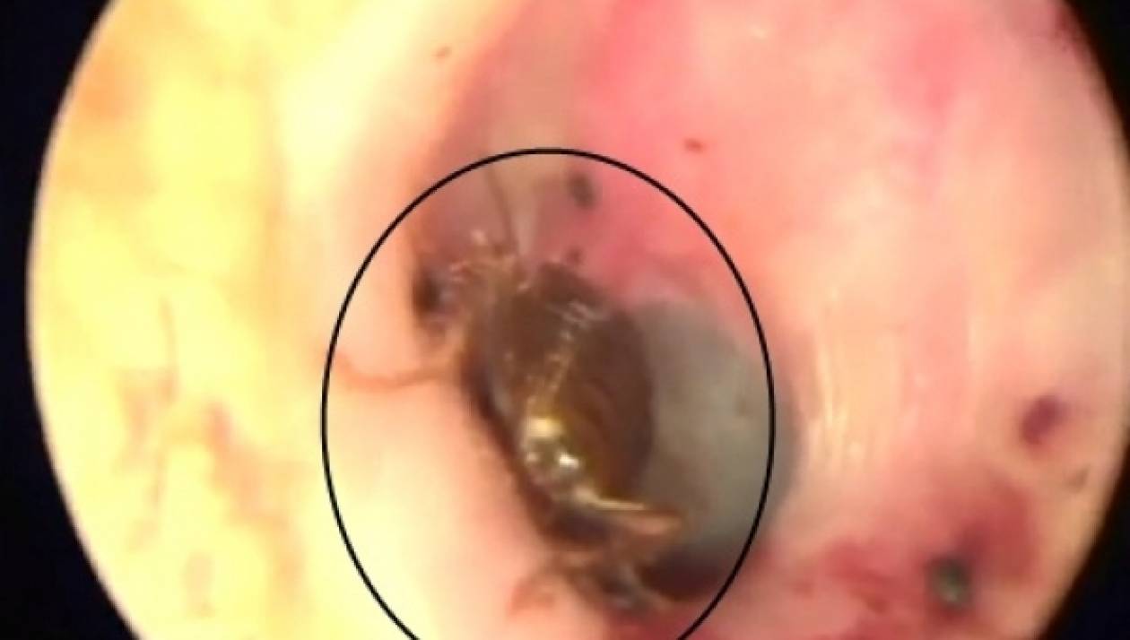 ΑΠΙΣΤΕΥΤΟ ΒΙΝΤΕΟ: Κατσαρίδα ζούσε μέσα στο αυτί ενός ανθρώπου