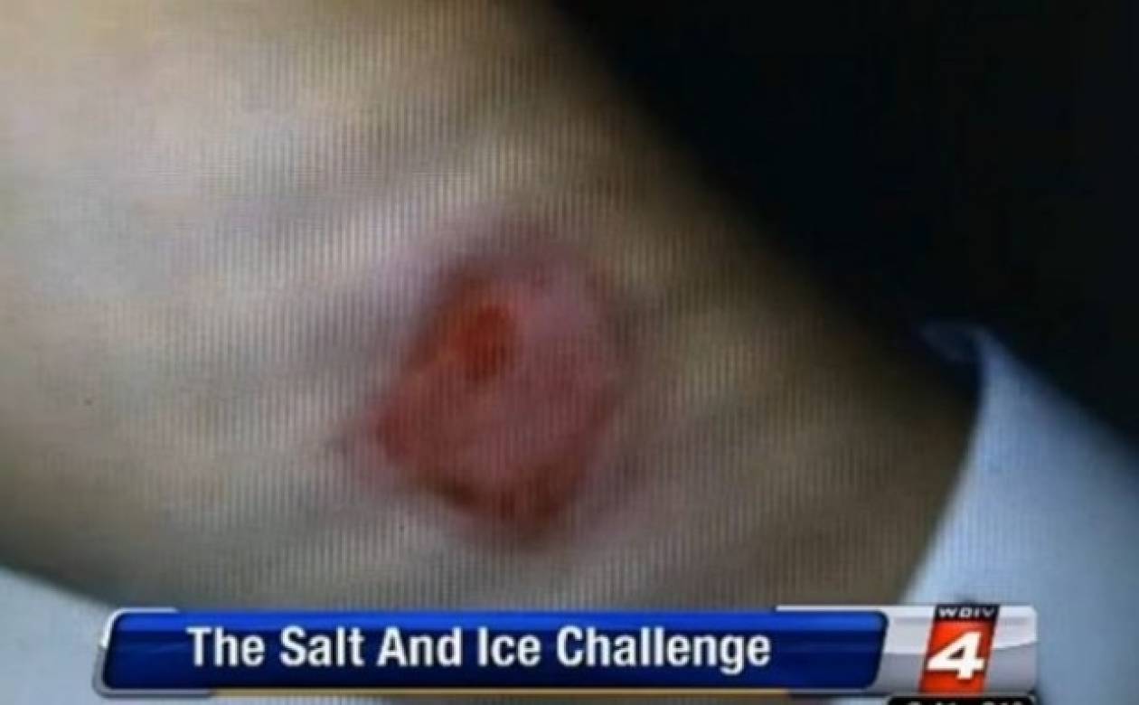 Νέα επικίνδυνη μόδα: Έφηβοι αυτοτραυματίζονται με πάγο και αλάτι!