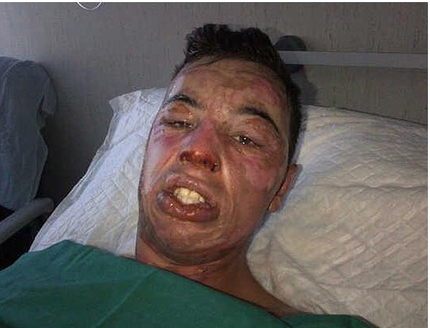 ΣΟΚ: Πήρε φωτιά το προσώπό του από φλεγόμενο σφηνάκι(pics)