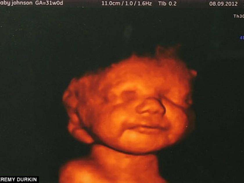 Είδε το αγέννητο μωρό της να χαμογελά και δεν έκανε έκτρωση