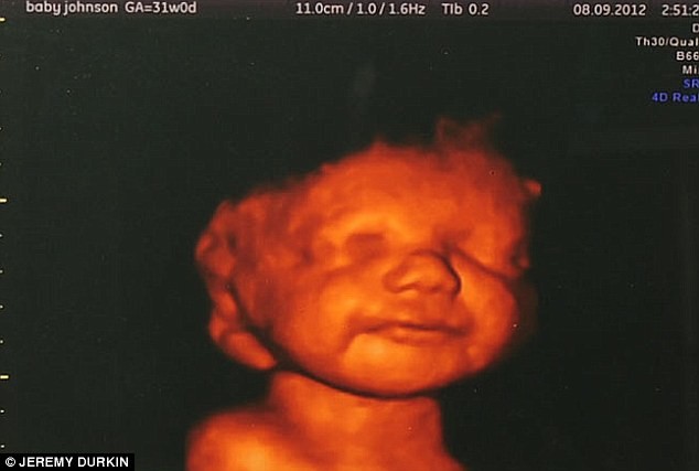 Είδε το αγέννητο μωρό της να χαμογελά και δεν έκανε έκτρωση