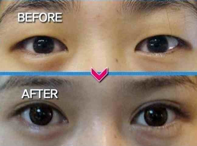 ΔΕΙΤΕ: Κορεάτες πριν και μετά την πλαστική