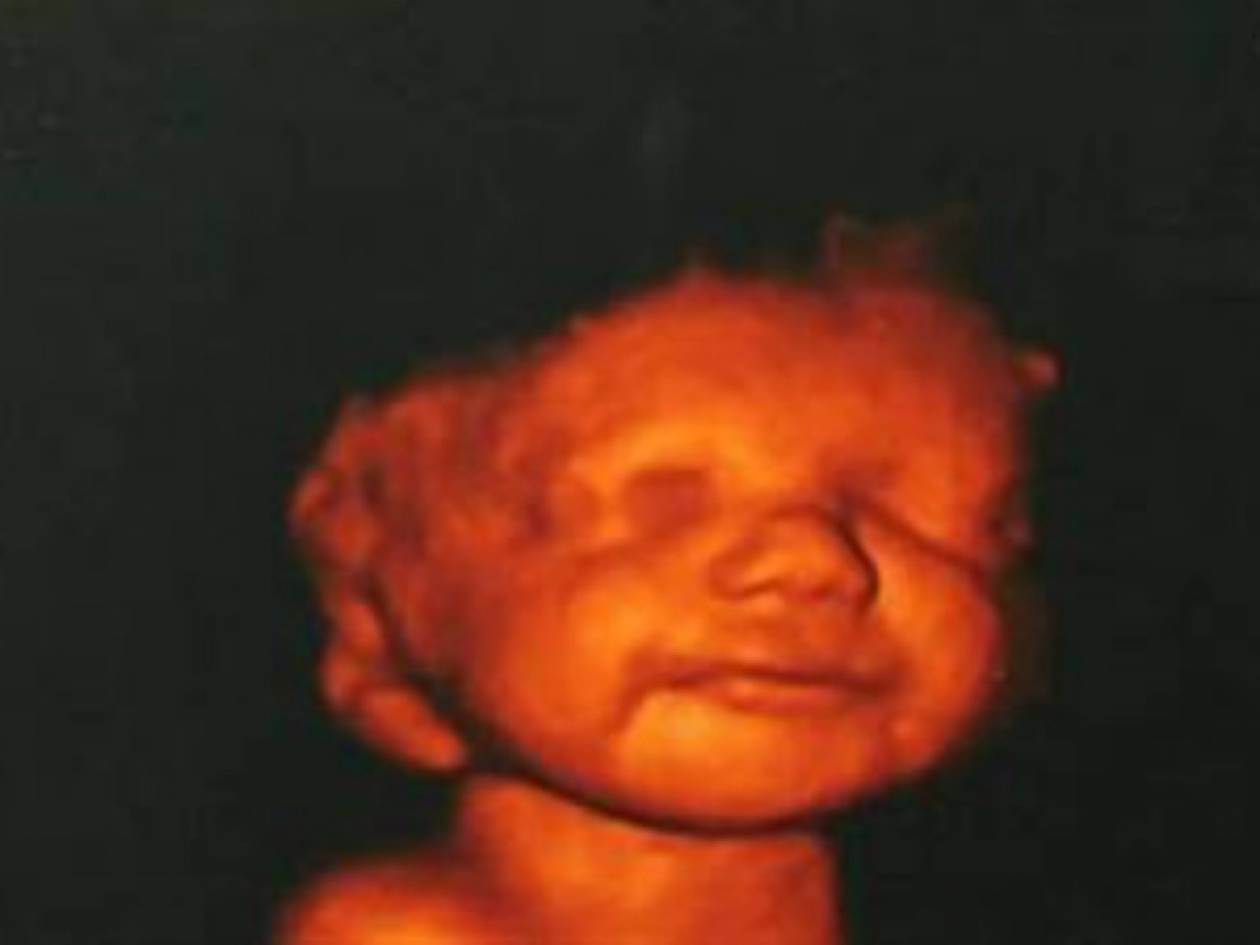 Aπίστευτο: Είδε το αγέννητο μωρό της να χαμογελά και δεν έκανε έκτρωση