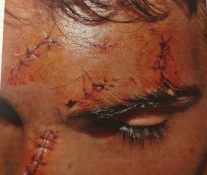 Άγρια ρατσιστική επίθεση σε 14χρονο-Τον χαράκωσαν στο πρόσωπο (pic)