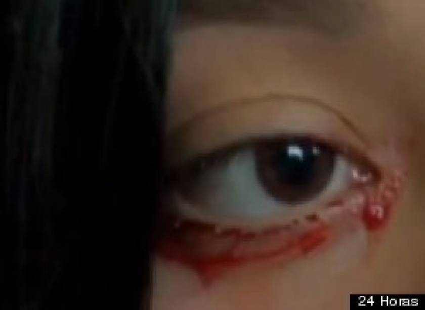 Βίντεο-ΣΟΚ: 20χρονη κοπέλα όταν κλαίει αντί για δάκρυα βγάζει αίμα