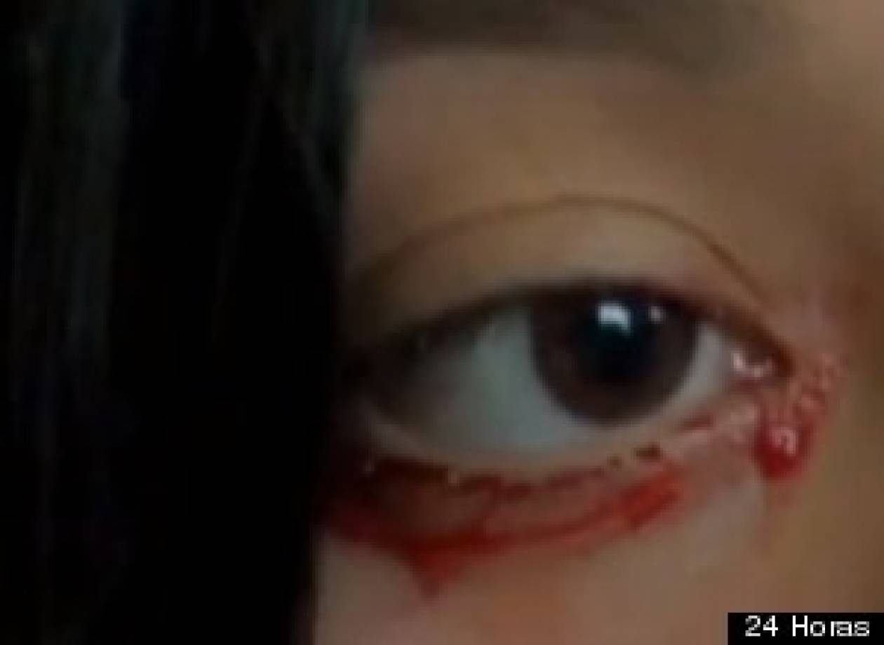Βίντεο-ΣΟΚ: 20χρονη κοπέλα όταν κλαίει αντί για δάκρυα βγάζει αίμα