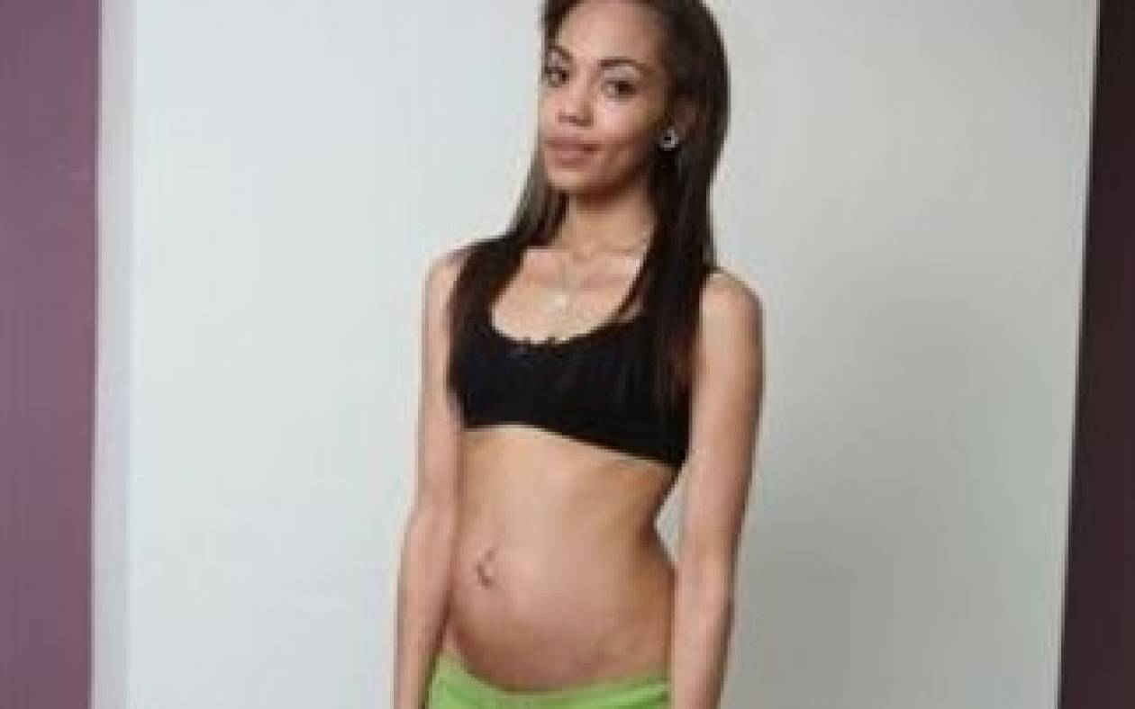 Σοκάρει η εικόνα της: Είναι έγκυος 8 μηνών και πάσχει από ανορεξία