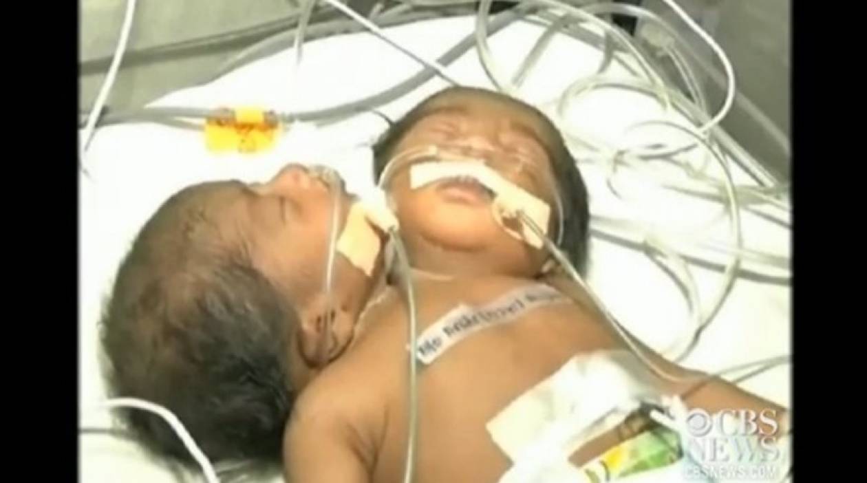 Μωρό με δύο κεφάλια γεννήθηκε στην Ινδία
