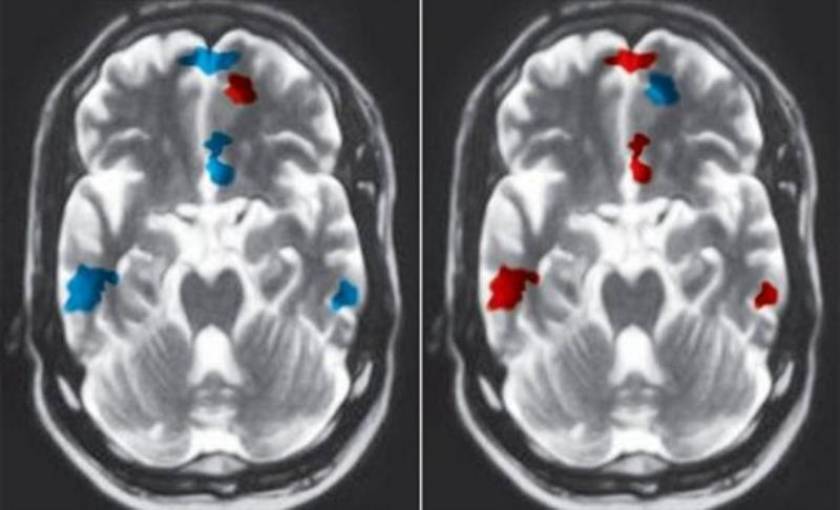 Η δυσλεξία είναι εμφανής σε απεικονιστικές εξετάσεις εγκεφάλου