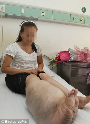 22χρονη ζούσε με έναν τεράστιο όγκο στο πόδι