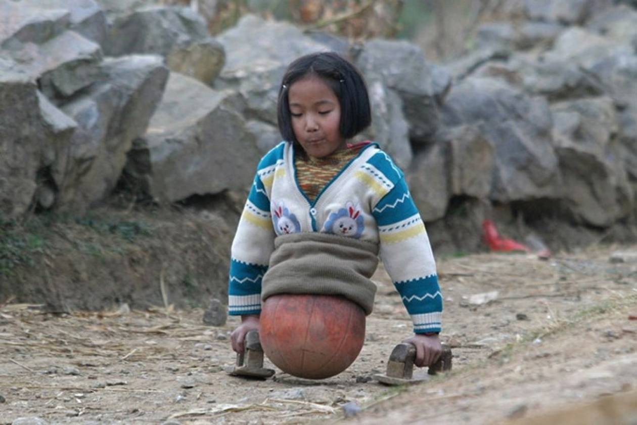 Σοκαριστικό: 4χρονη αντί για πόδια στηρίζόταν σε μια μπάλα
