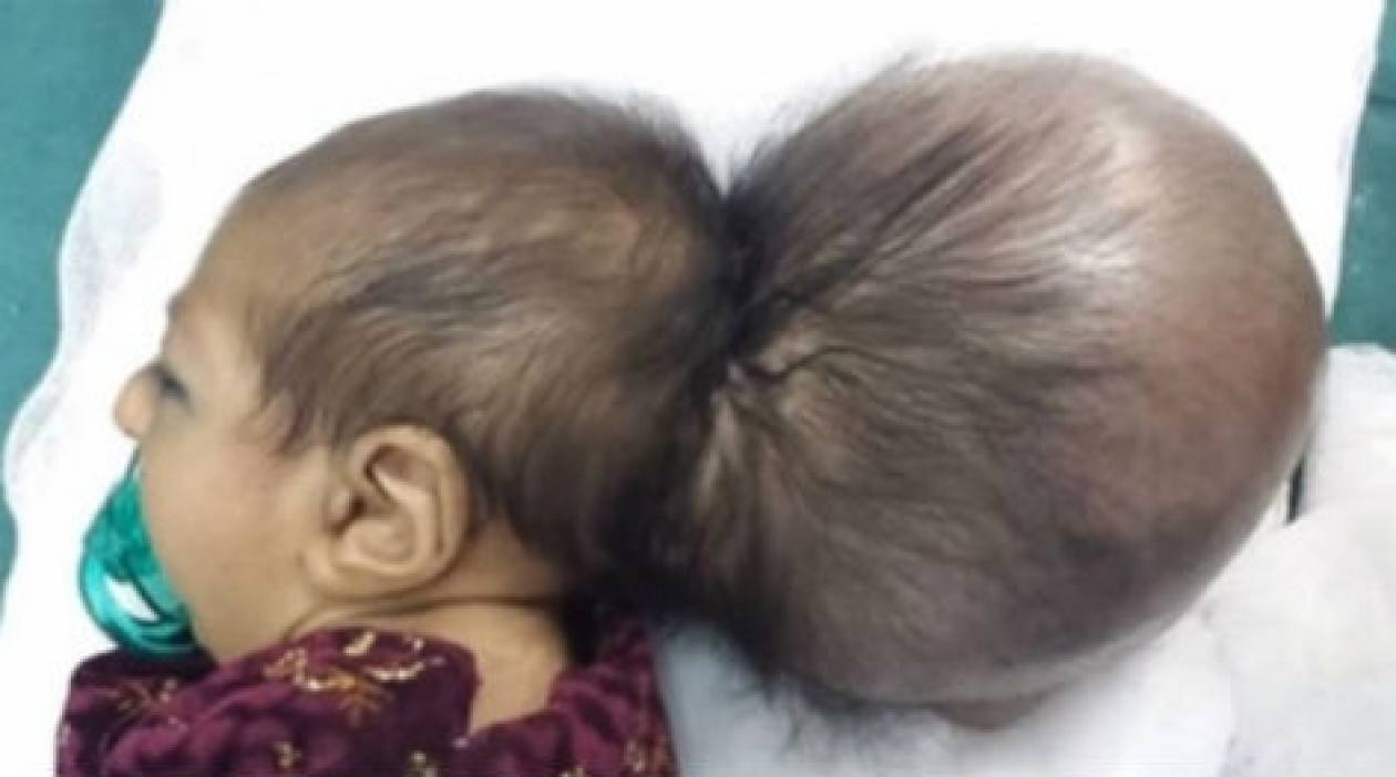 ΣΟΚ: Μωρό γεννήθηκε με δυο κεφάλια
