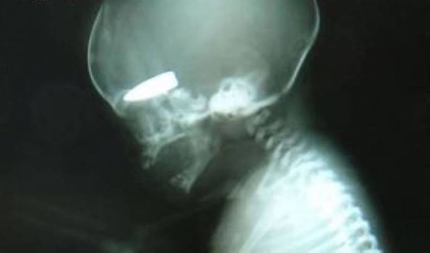 ΣΟΚ: Έμβρυο με σφαίρα στο κρανίο από ελεύθερο σκοπευτή στη Συρία