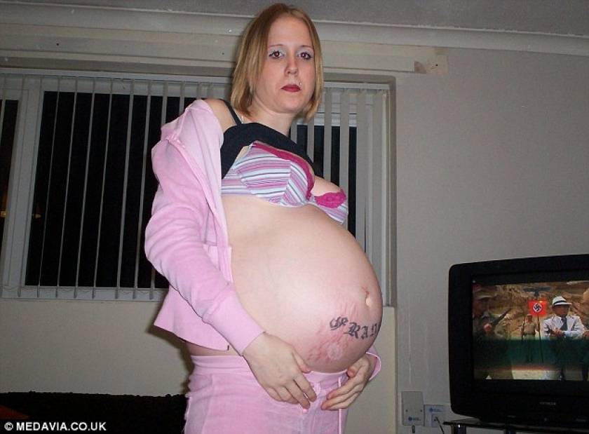 Σπάνια νόσος κάνει Βρετανίδα να μοιάζει έγκυος