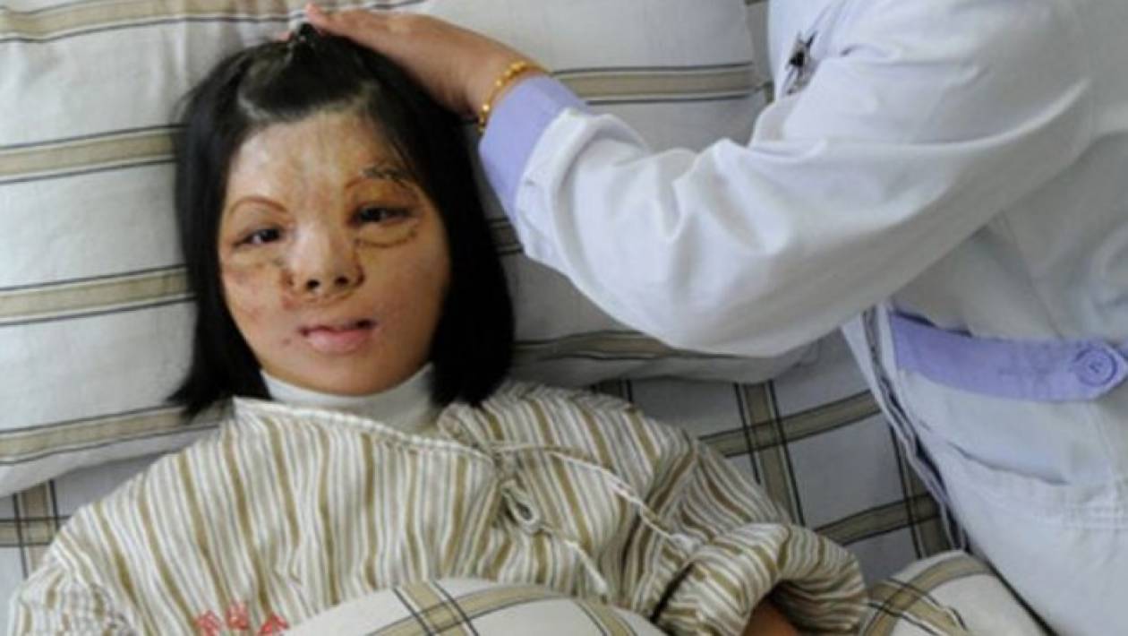 Απίστευτο: Γιατροί εμφύτευσαν το νέο πρόσωπό της στο στήθος της