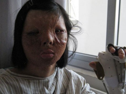 Απίστευτο: Γιατροί εμφύτευσαν το νέο πρόσωπό της στο στήθος της