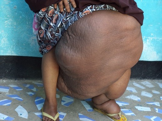 ΣΚΛΗΡΕΣ ΕΙΚΟΝΕΣ: Πάσχει από ελεφαντίαση - Το πόδι της ζυγίζει 31 κιλά