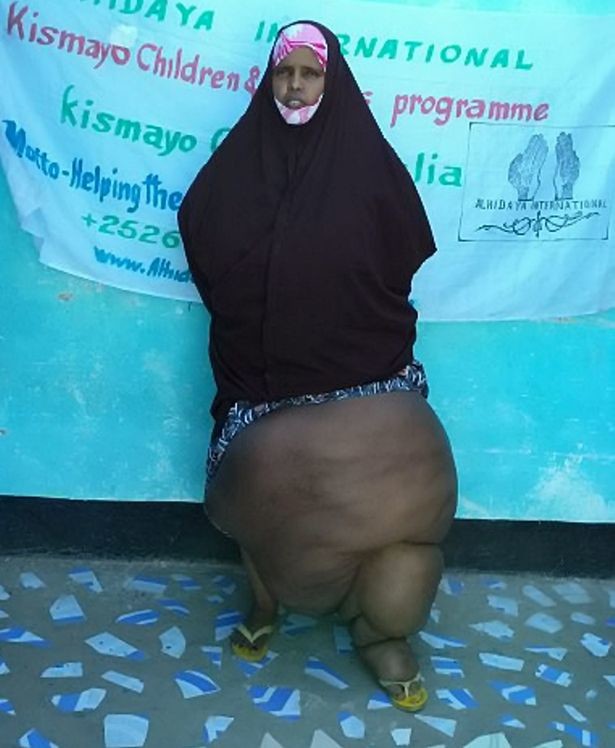 ΣΚΛΗΡΕΣ ΕΙΚΟΝΕΣ: Πάσχει από ελεφαντίαση - Το πόδι της ζυγίζει 31 κιλά