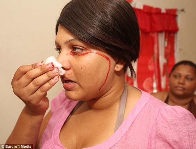 ΣΟΚ: 19χρονη κοπέλα όταν κλαίει αντί για δάκρυα βγάζει αίμα