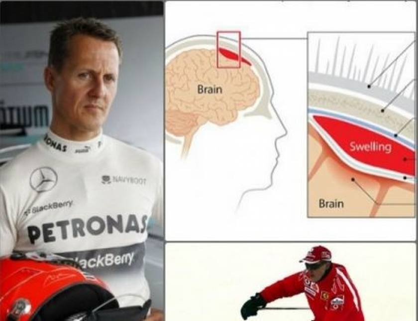 Michael Schumacher: Το υποσκληρίδιο αιμάτωμα και οι επιπτώσεις του