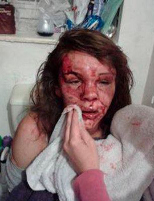 Εικόνες-ΣΟΚ: Την μαχαίρωσε στο πρόσωπο γιατί… τον είπε Χάρι Πότερ!