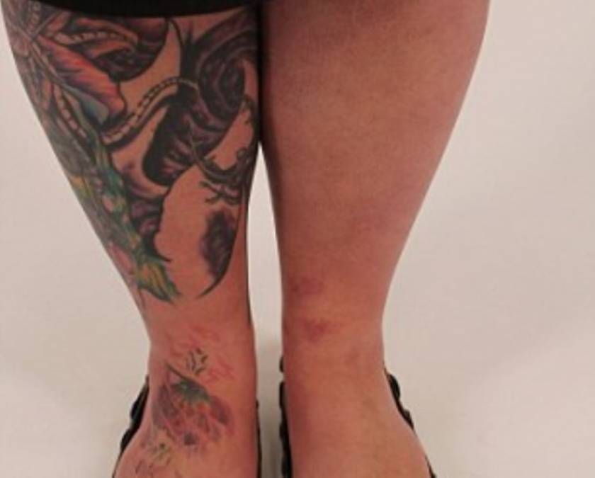 Κινδύνευσε να χάσει το πόδι της εξαιτίας ενός τατουάζ