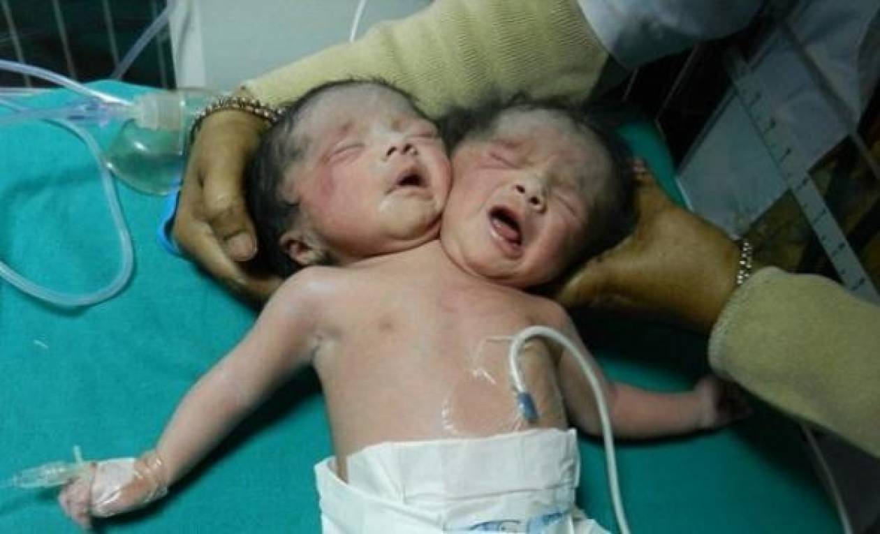 Γεννήθηκε μωρό με δύο κεφάλια (pics)