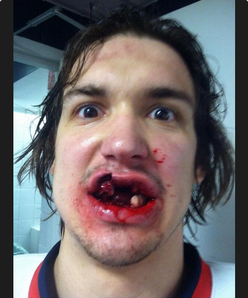 Σοκάρει η εικόνα τραυματισμένου παίκτη του χόκεϊ (photo)