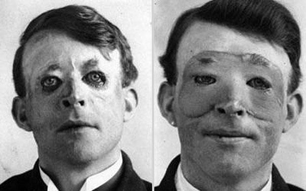 21-Walter-Yeo-one-of-the-first-to-undergo-an-advanced-plastic-surgery-and-a-skin-transplant-1917