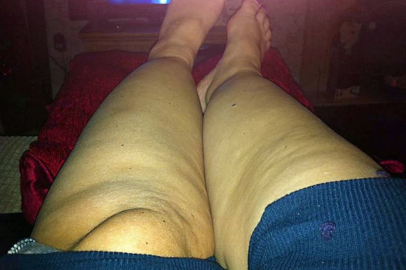Διαταραχή κάνει τα πόδια αυτής της γυναίκας να… (photos)