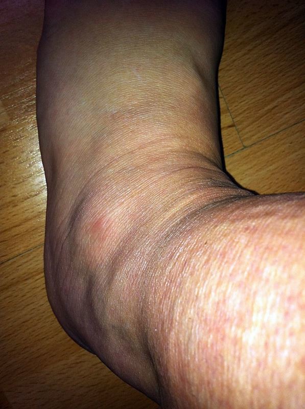 Διαταραχή κάνει τα πόδια αυτής της γυναίκας να… (photos)