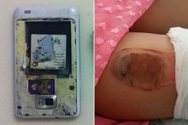 Κοριτσάκι χρειάστηκε μεταμόσχευση δέρματος από έκρηξη κινητού! (phs)