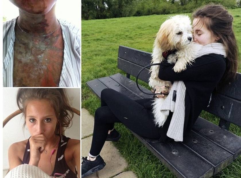 19χρονες δέχθηκαν απάνθρωπη επίθεση με οξύ (pics)