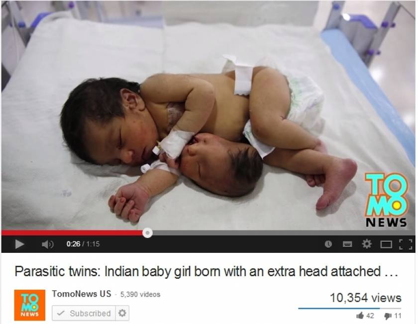 Γεννήθηκε μωρό με ένα επιπλέον κεφάλι στο στομάχι του! (βίντεο)