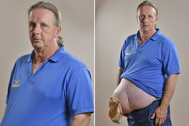 Λονδίνο: Κουβαλά μια τεράστια κήλη στην κοιλιά του! (photos)