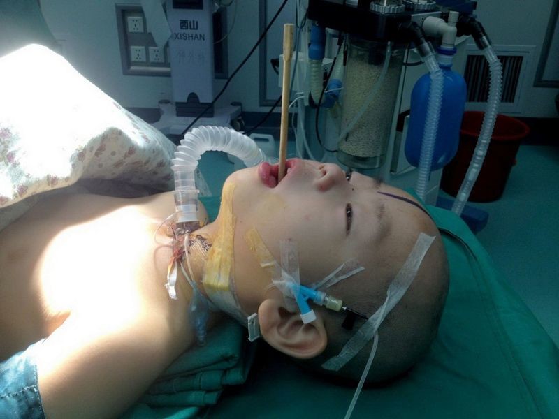 Κίνα: Ξυλάκι φαγητού καρφώθηκε στον εγκέφαλο αγοριού! (σκληρές εικόνες)