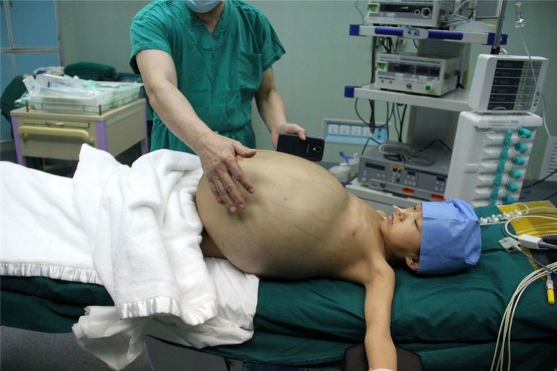 Κίνα: Αφαιρέθηκε όγκος 15 κιλών από την κοιλιά κοριτσιού! (photos)