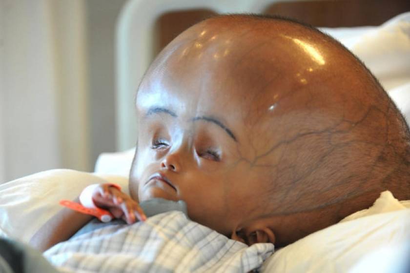Απίστευτο: Δείτε το μωρό με το τεράστιο κεφάλι! (pics+video)