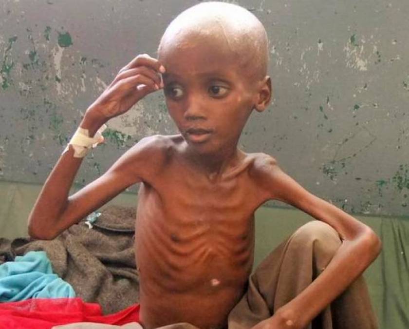 Somalia: Alarming levels of malnutrition