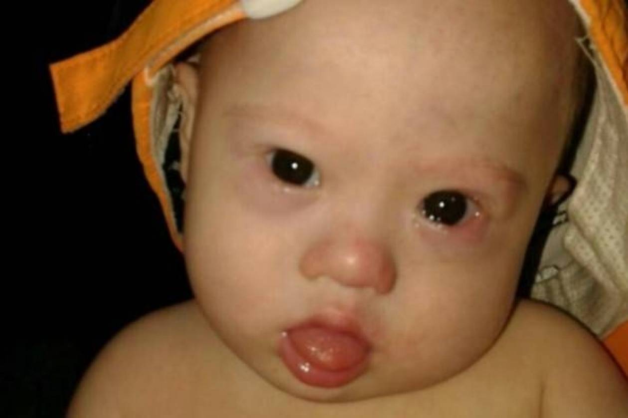 Τραγικό: Εγκατέλειψαν μωρό που είχε σύνδρομο Down (pics)