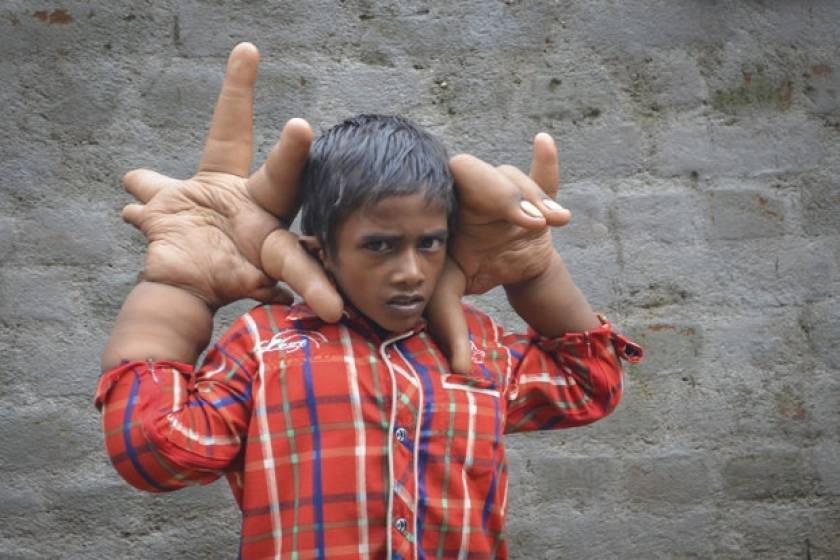 Αυτό είναι το αγόρι με τα τεράστια χέρια που ζυγίζουν 12,5 κιλά! (pics)