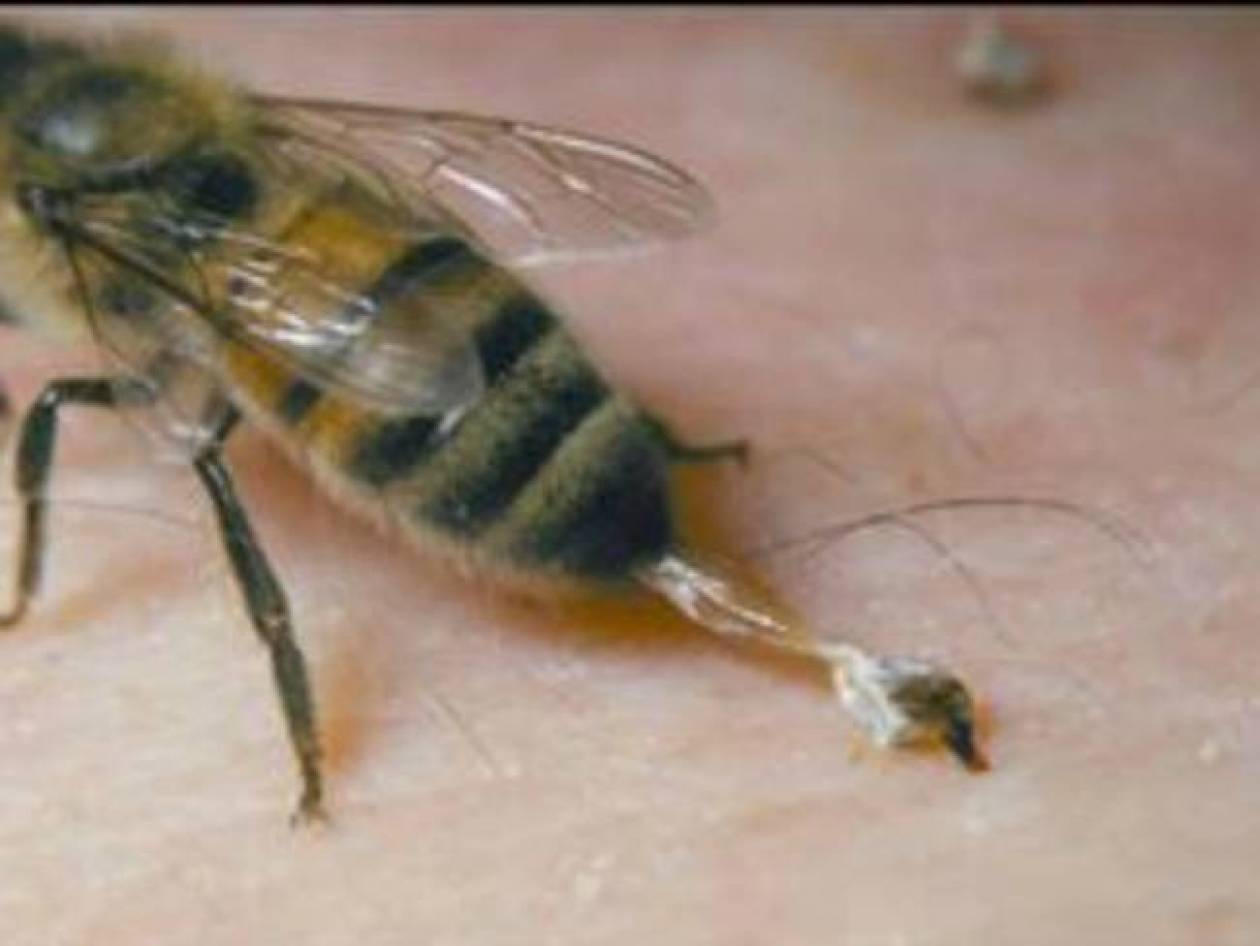 Τρίκαλα: Σε κρίσιμη κατάσταση 48χρονος από τσίμπημα σφήκας