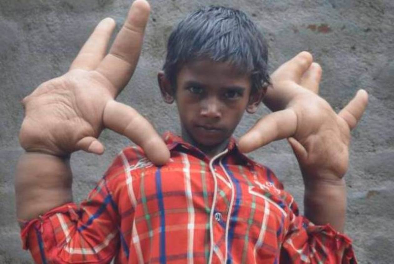 Ινδία: Το αγοράκι με τα μεγαλύτερα χέρια στον κόσμο! (video+photos)