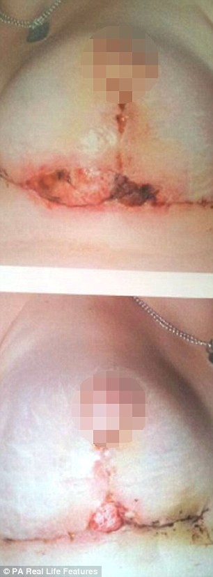 Έσκασαν τα εμφυτεύματα μέσα στο στήθος της! Προσοχή: Σκληρές εικόνες