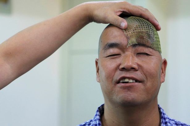 Κίνα: Εκτυπωτής 3D τού έδωσε πίσω το μισό του κρανίο! (photos)